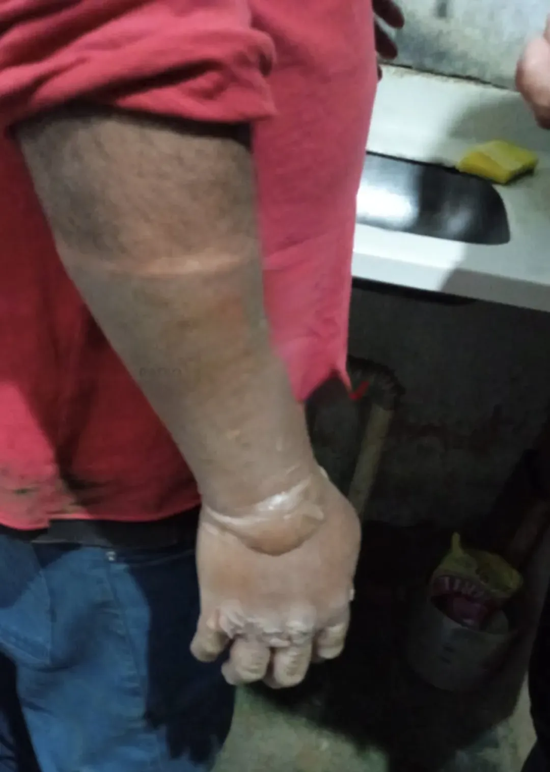 Hombre sufre quemaduras al manipular garrafa de gas en Zanja Pytã ...