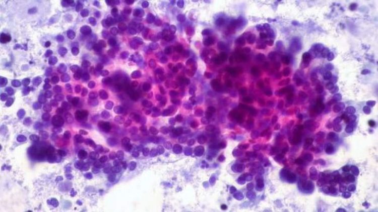 El ADN de 12.000 tumores revela un "tesoro oculto" de las causas del cáncer