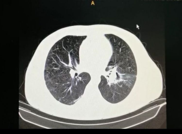 Descubren dos casos de "hongo negro" post coronavirus