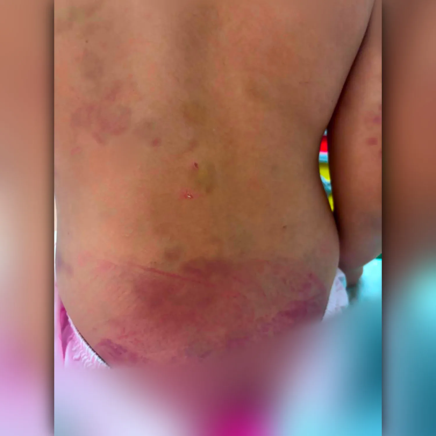 Niña autista queda internada tras sufrir brutales maltratos por su padrastro en Pedro Juan