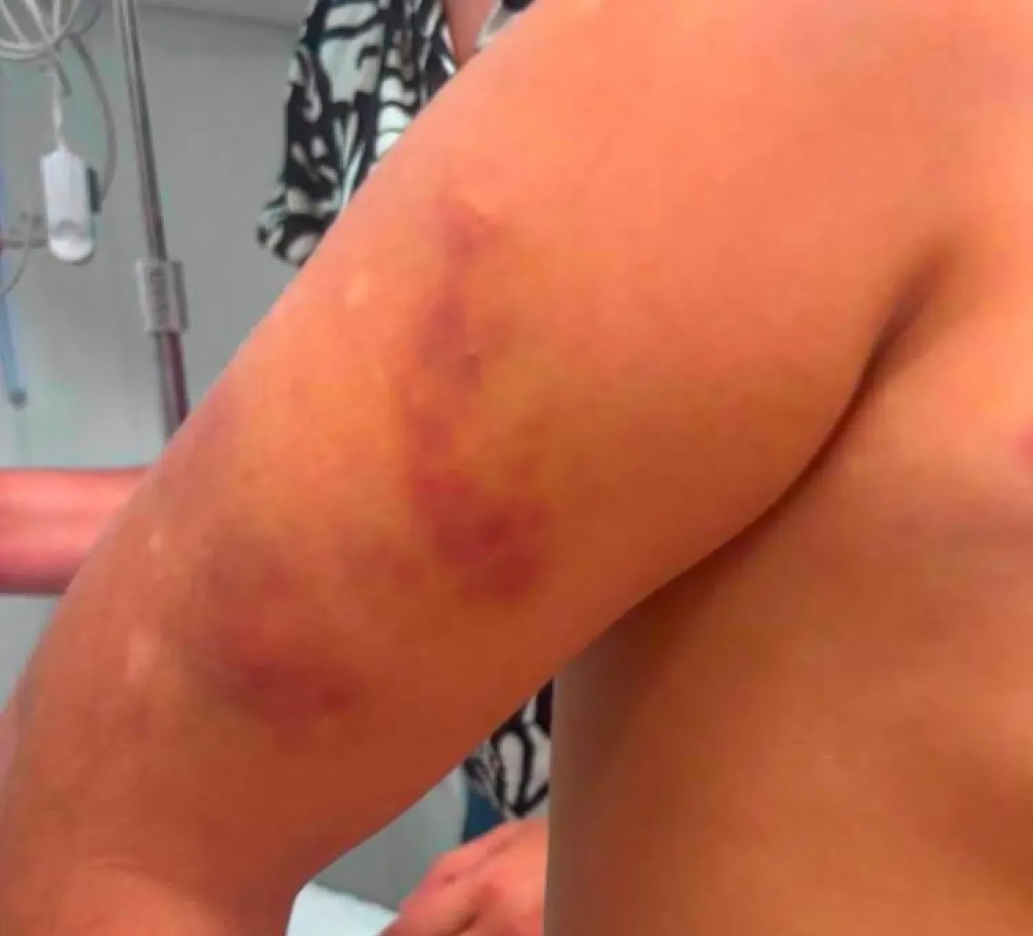 Forense detalla el estado de la niña autista golpeada por su padrastro en Pedro Juan Caballero